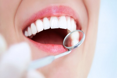  Čišćenje kamenca. Akcija